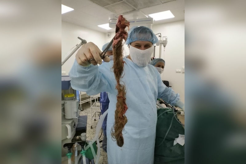 Врачи достали из желудка 21-летней жительницы Подмосковья три килограмма волос