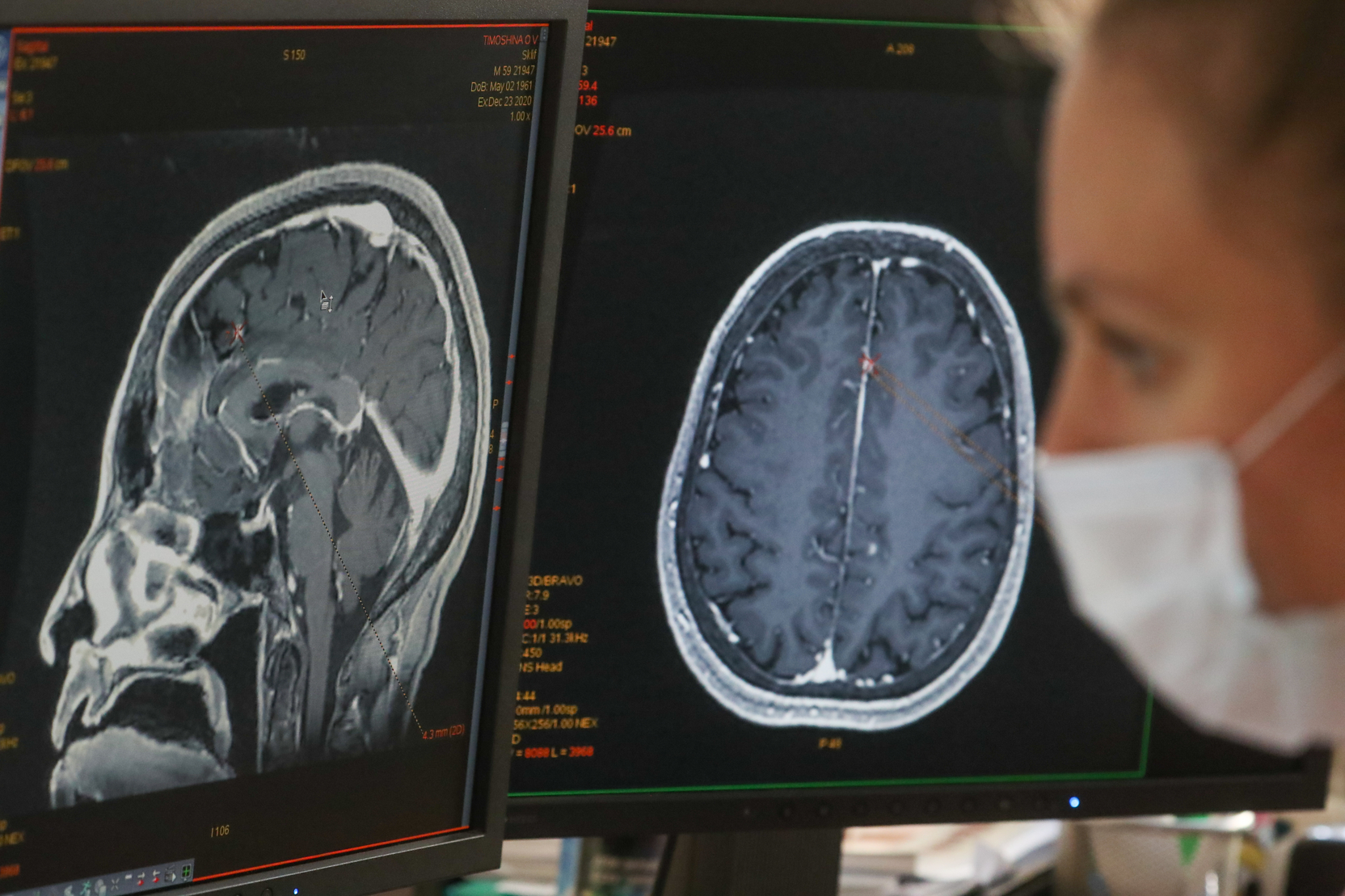 Компания Neuralink заявила о проблемах у первого обладателя ее мозгового чипа
