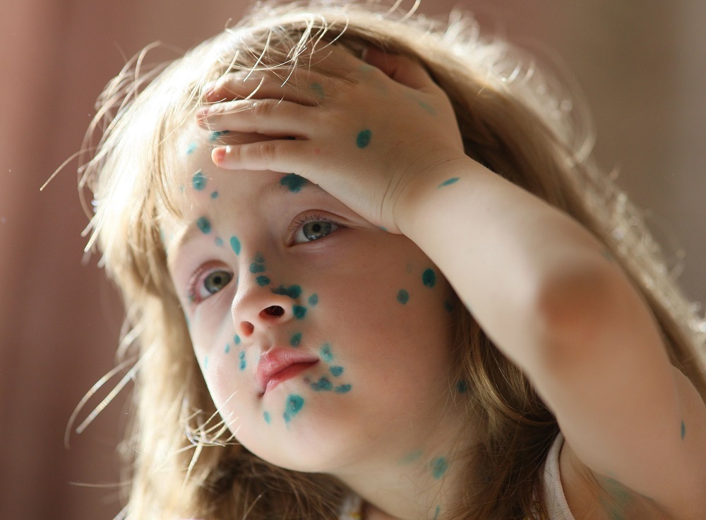 СМИ: В Петербурге выявили случай оспы обезьян